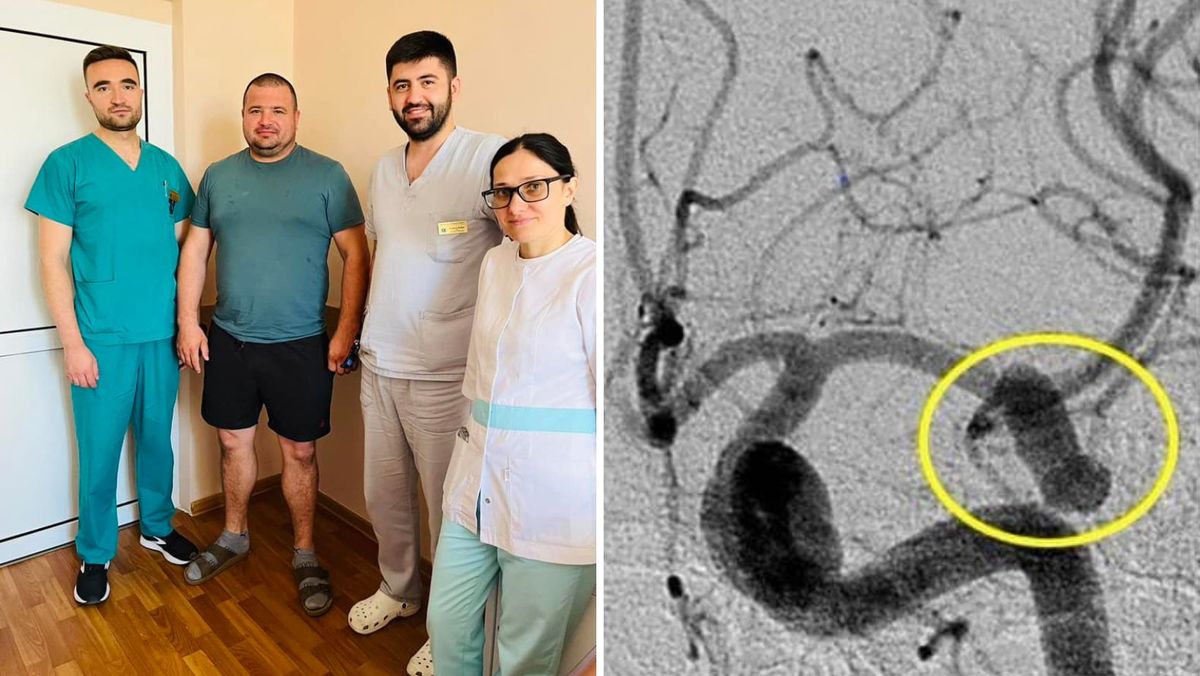 Un bărbat diagnosticat cu anevrism gigant a primit a doua șansă la viață