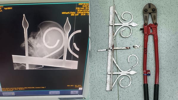 O fetiță de 5 ani, operată de urgență după ce a căzut peste gardul unei biserici. Cum se simte