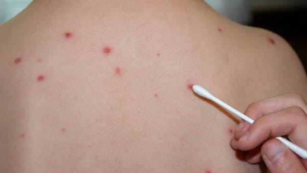 Un copil din capitală a fost diagnosticat cu rujeolă. Familia revenise recent de la munte din Ucraina