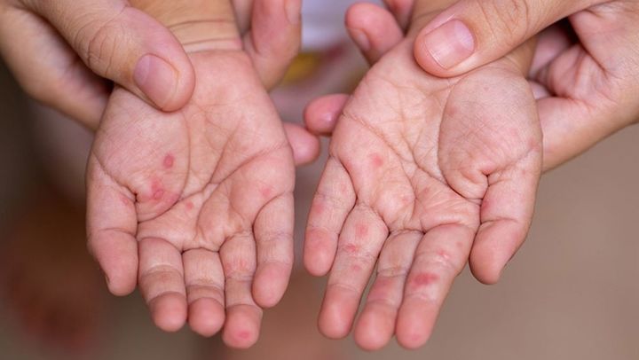 Trei cazuri noi de rujeolă, fixate în capitală. Părinții sunt îndemnați să-și vaccineze copiii